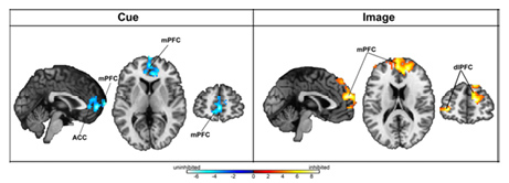Vanderbilt investigators found that inhibited children had too little prefrontal cortex activation (shown in blue at left) when they saw a cue that predicted seeing a face showing a fearful expression, and too much prefrontal cortex activation when actually viewing the face (shown in orange at right).